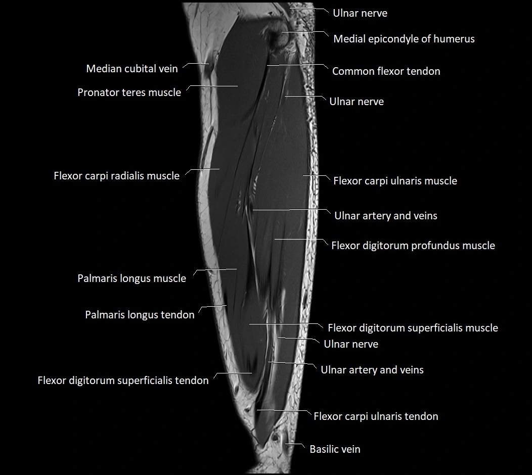 MRI 3T forearm sagittal labelled cross sectional anatomy image 31.webp